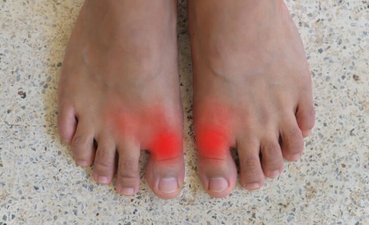 Pain in the big toes with gout